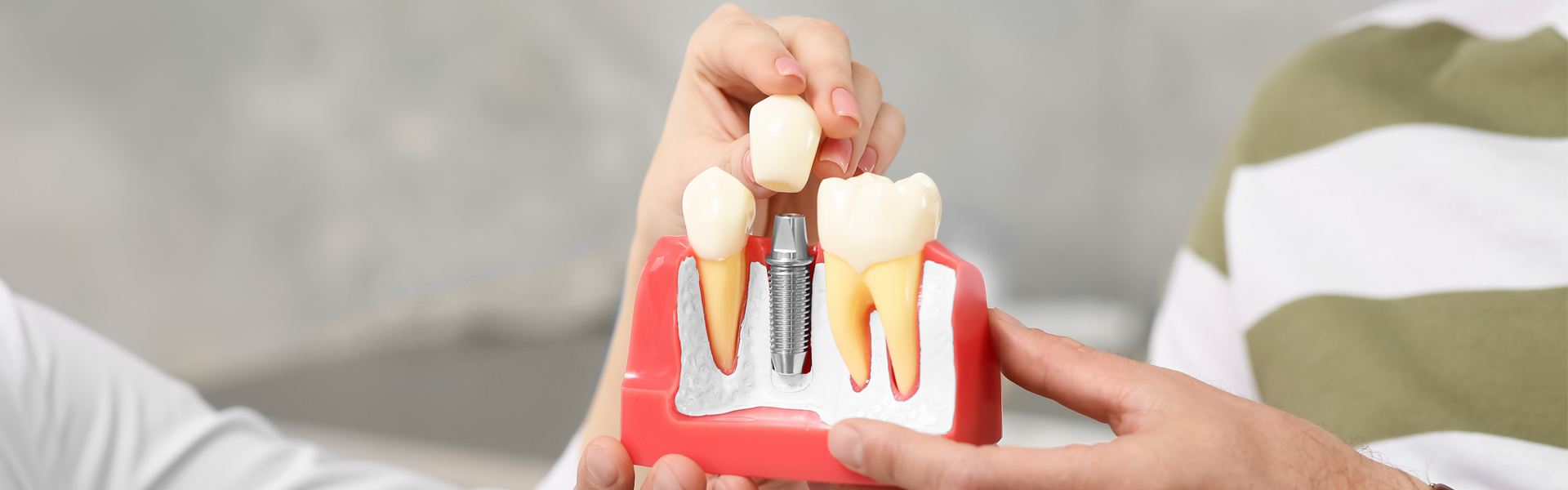 Temporary Dental Implants: A Great Option For Patients Who Do Not Want To Wear A Removable Denture appliance