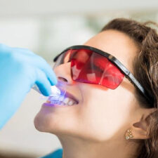 Is Professional Teeth Whitening in Citrus Heights Worth It?