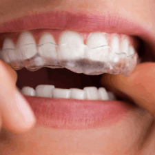 CandidPro Aligners