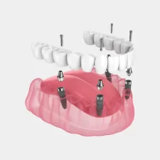 All-on-4 vs. All-on-6 Dental Implants: What’s the Difference and Which Is Better?